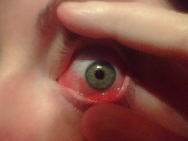 eye drops, conjunctivitis